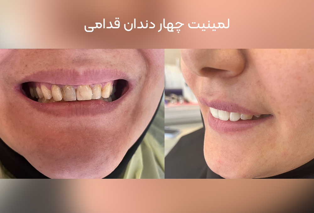 نمونه کامپوزیت دندان در کرج